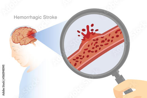Brain scan of old man with Magnifying glass to zoom on artery of brain with bleeding. Illustration about Hemorrhage Stroke of Elderly.