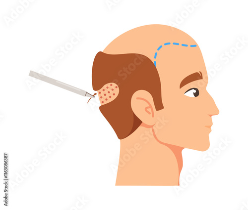 Hair transplantation procedure vector illustration