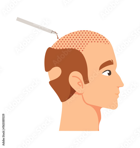 Hair lost treatment, follicular transplantation