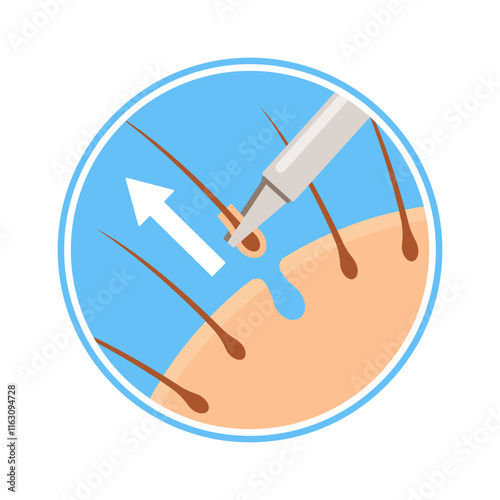Follicular unit extraction procedure vector illustration
