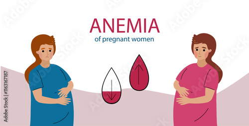 Pregnant women suffer from anemia. Anemia pregnancy infographic. Hypoglycemia concept. disease, Prevention. Vector illustration hand drawn flat