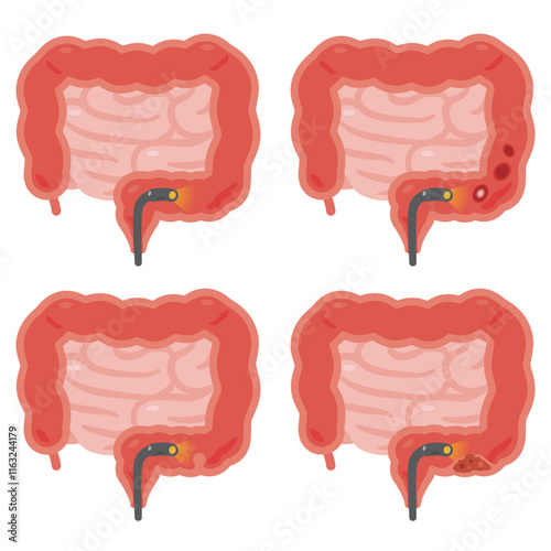 大腸カメラ検査を受ける色々な状態の腸のイラストセット