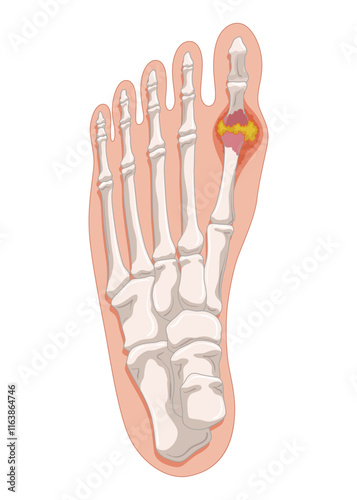 Gout diagram in human foot with crystallization of uric acid joint. Medical educational poster infographic scheme with inflammatory arthritis. Orthopedic disease vector illustration