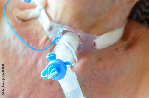 Tracheostomy is a procedure to help air and oxygen reach the lungs by creating an opening into the trachea (windpipe) from outside the neck.