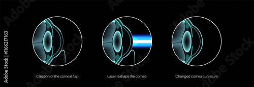 LASIK eye surgery