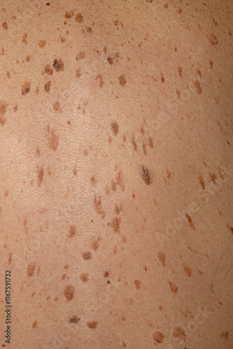 Brown spots and freckles on the back of an old man. Skin problems. photo