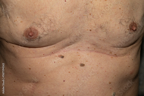 Brown spots, freckles on an old man's body. Skin problems. photo