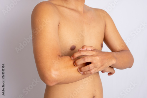 Dermatology, asian young man, man allergy, allergic reaction from atopic, insect bites on her arm, hand in scratching itchy, itch red spot or rash of skin. Healthcare, treatment of skin.