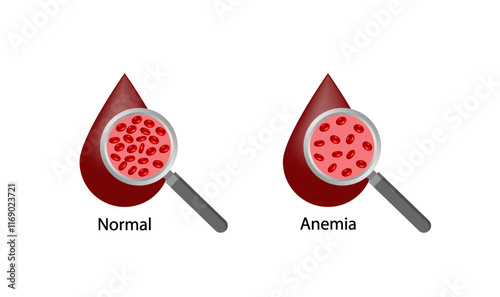Iron deficiency anemia. Normal blood and anemia. Blood droplet. Blood donation. Realistic vector 3d picture. Vector illustration isolated on white background.