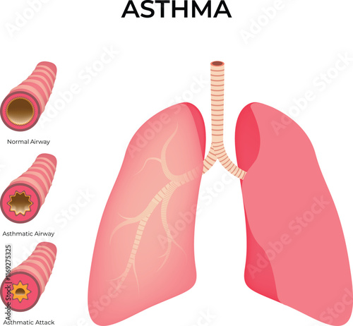 Asthma Normal Airway Asthmatic Airway Asthmatic Attack Design Vector Illustration