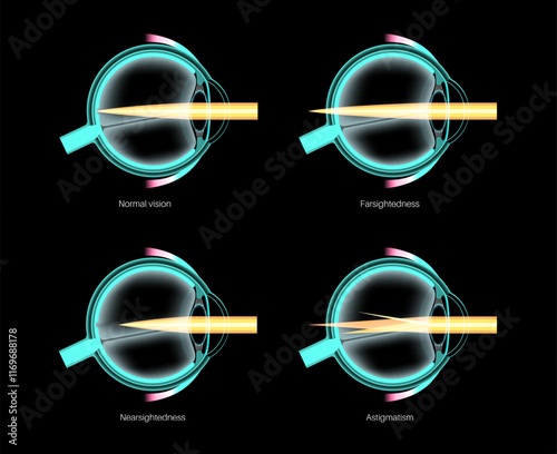 Refractive errors poster