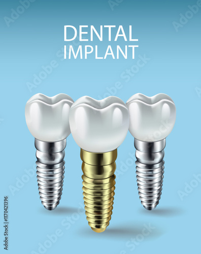 Dental implants on a light blue background, Vector illustration