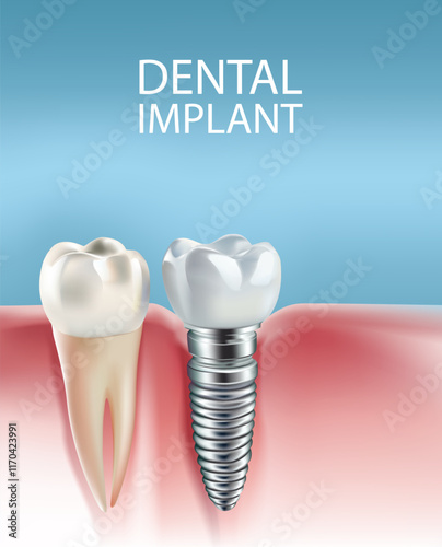 Dental implants on a light blue background, Vector illustration