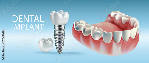 Dental implants on a light blue background, Vector illustration