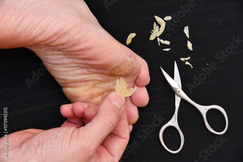 Man cuts rough scissors, calluses, corns on the soles. Foot care at home