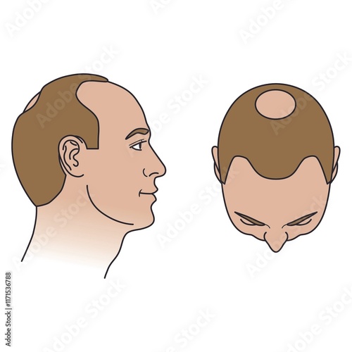 Stage 3 (Vertex) on The Norwood-Hamilton Scale of Male Hair Loss photo