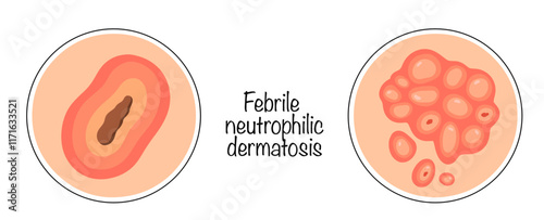 Febrile neutrophilic dermatosis
