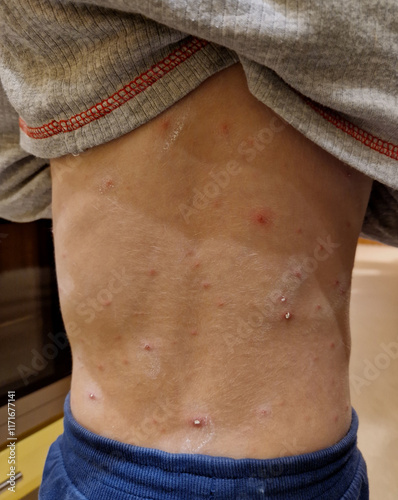 Chickenpox is one of the most common infectious diseases in the world. The course of the disease is usually not serious, but severe complications can occur photo