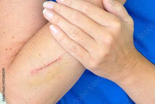 Wallpaper Mural Treating a deep cut on the hand  Scar on hand. Cut and wound in the skin.. Torontodigital.ca