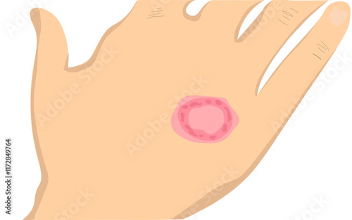 ringworm on the hands