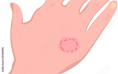ringworm on the hands