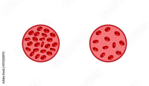 Iron deficiency anemia. The difference of Anemia amount of red blood cells and normal. Blood donation. Realistic vector 3d picture. Vector illustration isolated on white background.