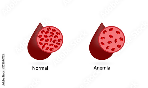 Iron deficiency anemia. Blood donation. Realistic vector 3d picture. Vector illustration isolated on white background.