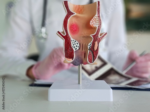 Anatomical model of rectum with hemorrhoids in clinic concept