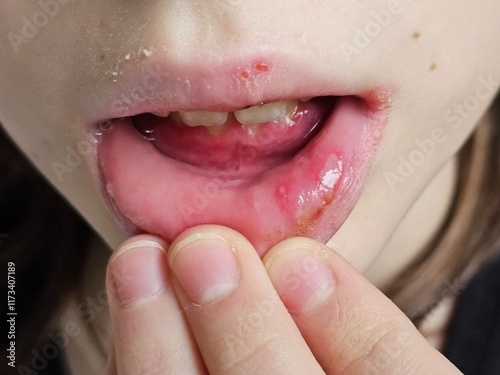 Tongue and lips and infectious disease herpes simplex virus cells