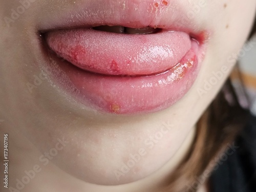 Infectious disease herpes simplex virus cells