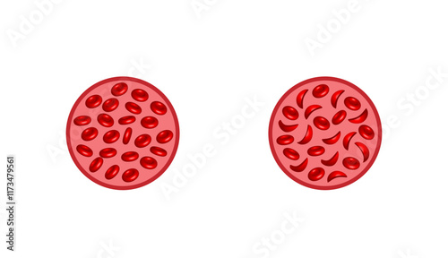 Sickle cell anemia. Normal red blood cells and sickle cells. Vector illustration isolated on white background.	