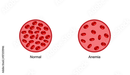 Iron deficiency anemia. Normal blood and anemia. Blood donation. Realistic vector 3d picture. Vector illustration isolated on white background.