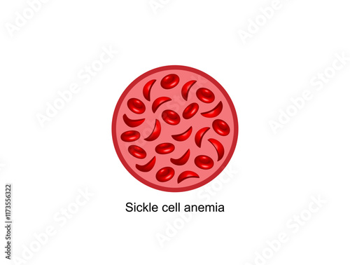 Sickle cell anemia. Vector illustration isolated on white background.
