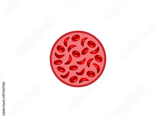 Sickle cell anemia. Vector illustration isolated on white background.	