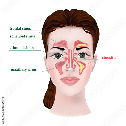 The face of a girl with the anatomy of the maxillary sinuses, with a description. The disease is sinusitis. Medical poster, infographics
