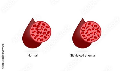 Sickle cell anemia. Normal red blood cells and sickle cells. Vector illustration isolated on white background.