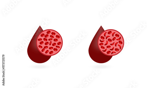 Sickle cell anemia. Normal red blood cells and sickle cells. Vector illustration isolated on white background.	