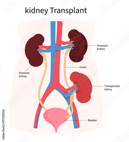 Kidney transplantation for end stage renal failure