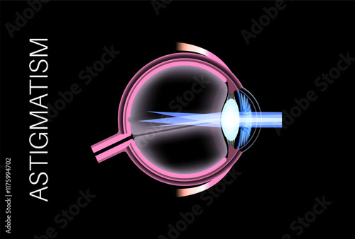 Astigmatism eye disease