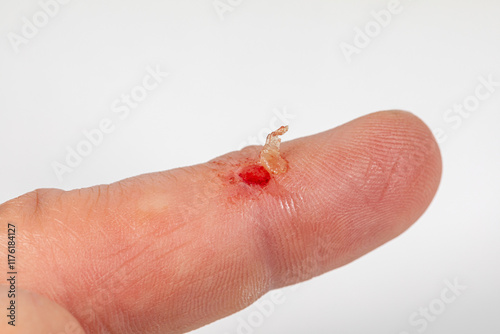 Skin tear wound on finger. First aid, cut injury care and medical treatment concept.