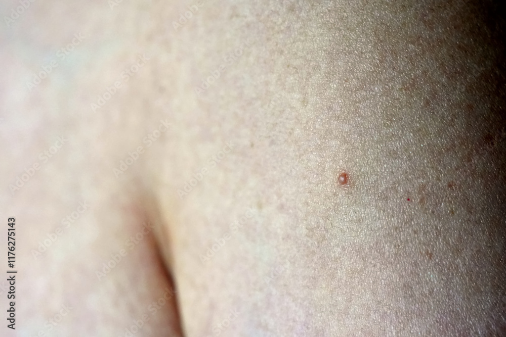 Fototapeta premium Folliculitis on human arm treatment.