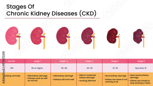 Stages of Chronic Kidney Disease (CKD) Infographic – Kidney Health Progression Chart