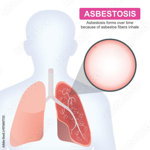 Asbestosis inhaling asbestos fibers illustration
