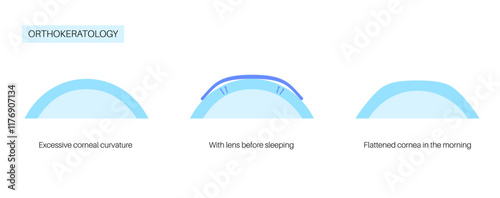 Orthokeratology contact lens