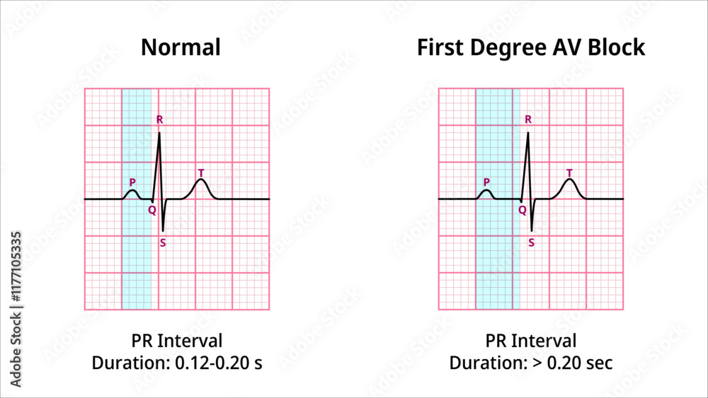 Comparison of AV Block Degree 1 and Normal ECG Waveforms - Medical Vector Illustration