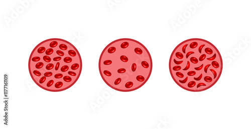 Iron deficiency anemia. Sickle cell anemia. Vector illustration isolated on white background.	