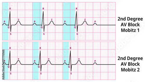Comparison of AV Block Degree 2 Mobitz Type 1 and Type 2 ECG Waveforms - Medical Vector Illustration