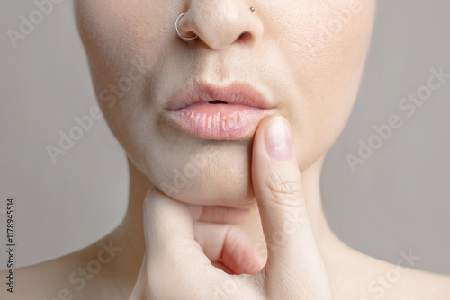 Woman with dry lips, Dry, chapped, peeling lips, dry skin problem with mouth disease close up