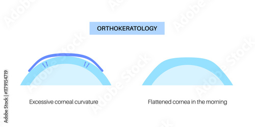 Orthokeratology contact lens