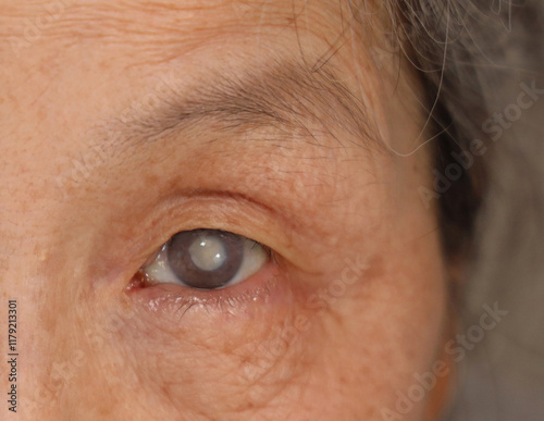 Close up of female elderly body eye (cataract)